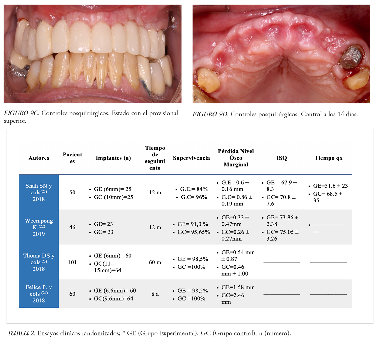 Utilización Clínica De Implantes Cortos Y PRFG Como Alternativa En La ...